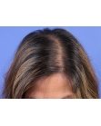 Before Hair Transplant &nbsp;Hair Thinning